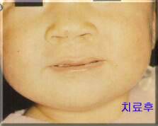 치료 후