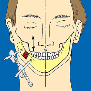 하악골 신연술 후