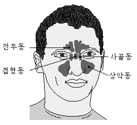 치성 상악동염을 보여주는 참고 그림 1