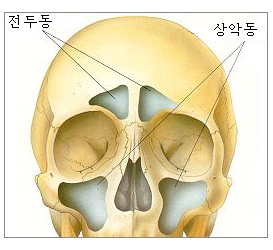 치성 상악동염을 보여주는 참고 그림 2