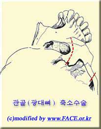 관골 축소술 절단선
