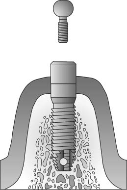 4단계: 보철물 연결