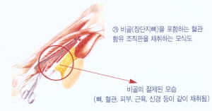 비골 유리피판을 이용한 아래턱 재건 (술전/술후)