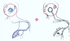 뺨 결손의 피판 재건 모식도