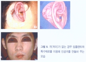 입천장·잇몸 결손 재건 모식도 1