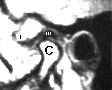 정상 턱관절 MRI